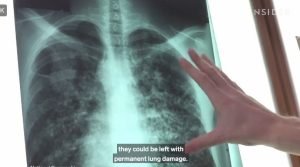 Primul transplant de plămân de porc la ființă umană: organul a funcționat timp de nouă zile și poate reprezenta o soluție pentru deficitul global de organeea noastră”