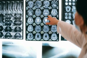 Cum poate AI să crească de trei ori șansele de recuperare completă după un AVC