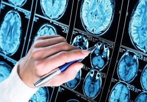Nou instrument AI identifică leziuni cerebrale ascunse la copiii cu epilepsie