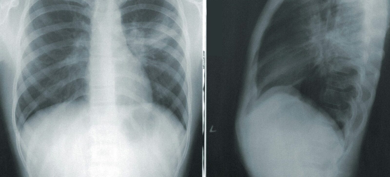 Tuberculoza, principala cauză de deces cauzată de boli infecțioase la nivel global, a provocat moartea a 1,23 milioane de oameni în 2024, conform Organizației Mondiale a Sănătății