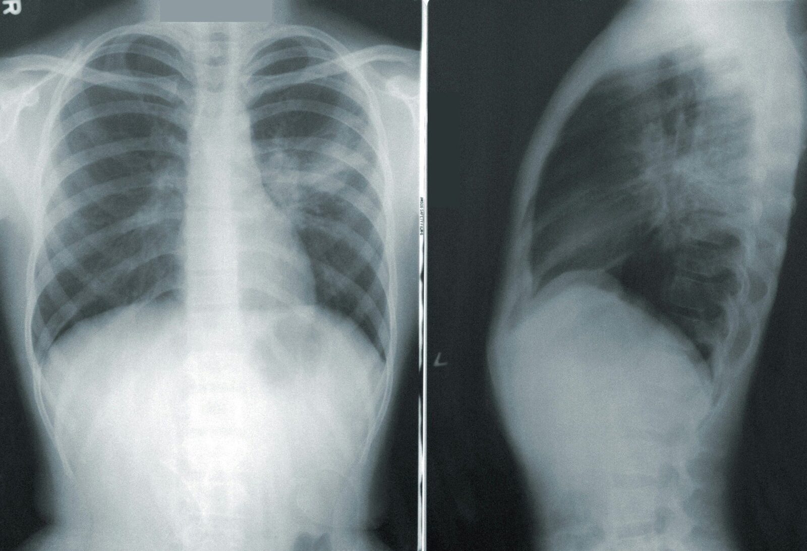 Tuberculoza, principala cauză de deces cauzată de boli infecțioase la nivel global, a provocat moartea a 1,23 milioane de oameni în 2024, conform Organizației Mondiale a Sănătății