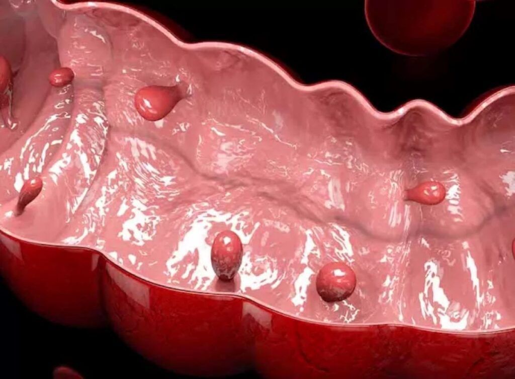 Polipii sesili: Leziunea tăcută din colon ce crește riscul de cancer. Când devin periculoși? (69 caractere)