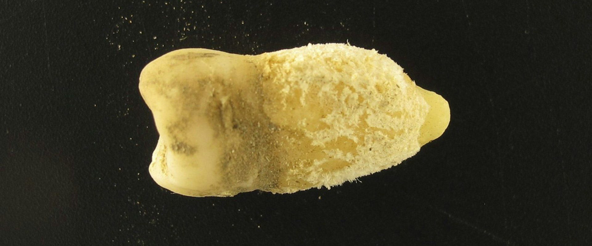 Bacterie de scarlatină, găsită într-o mumie! Descoperirea uluitoare schimbă istoria