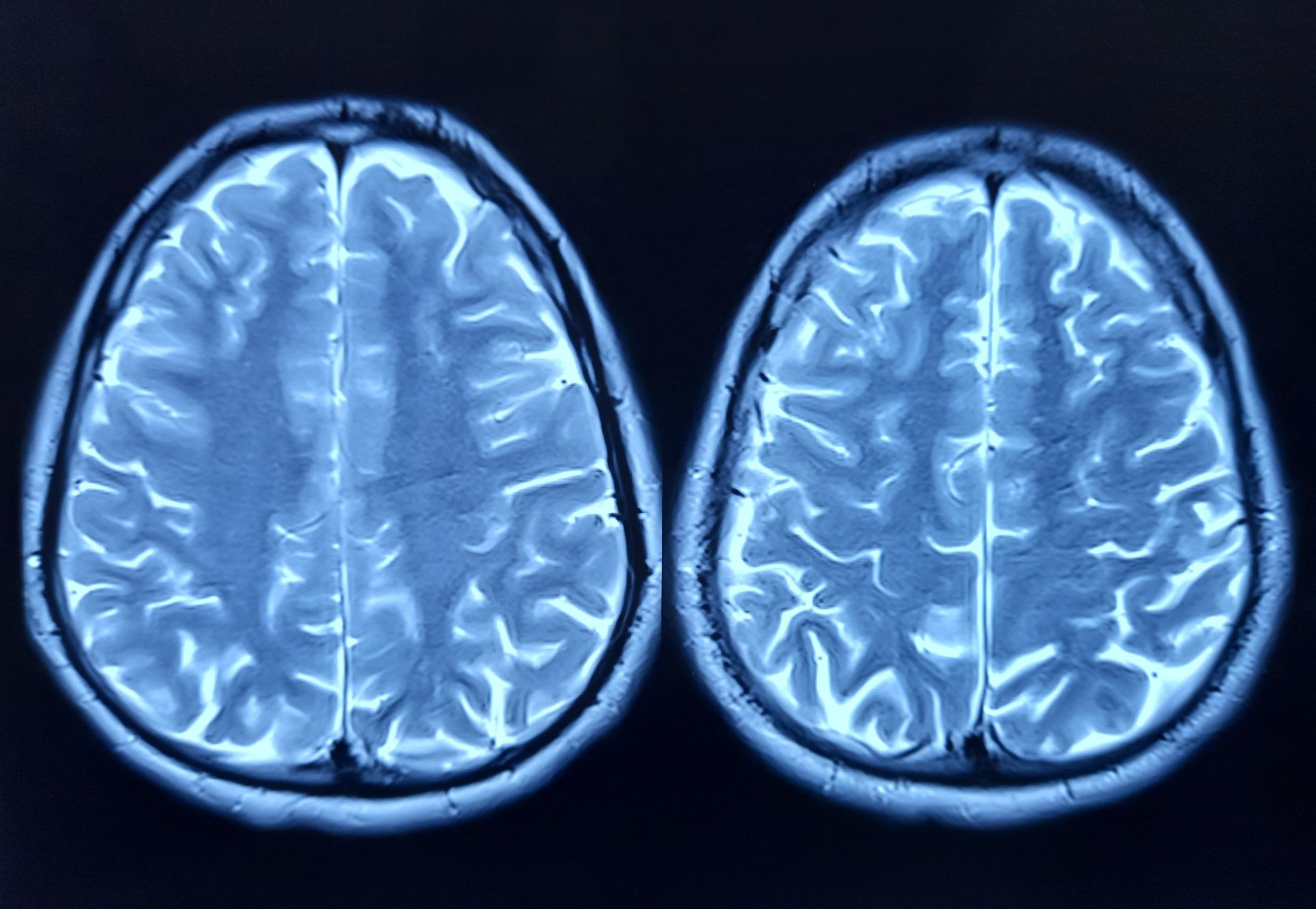 O proteină ar putea fi cheia misterului îmbătrânirii creierului, arată un studiu recent