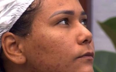quais são os cuidados ideais para quem tem, como Chaiany, eliminada do 'BBB 26'? Cosmetóloga faz alerta e revela hábito indispensável na rotina de skincare