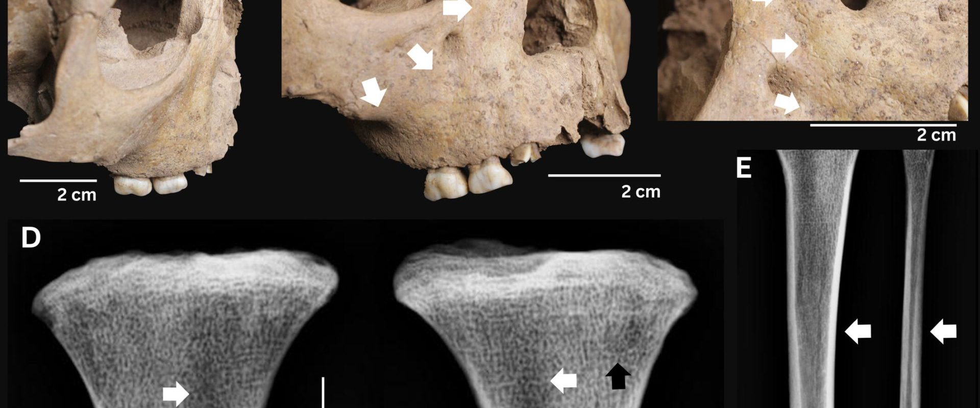 Dinții copiilor antici: Boala mortală care bântuia acum 4000 de ani