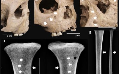 Dinții copiilor antici: Boala mortală care bântuia acum 4000 de ani