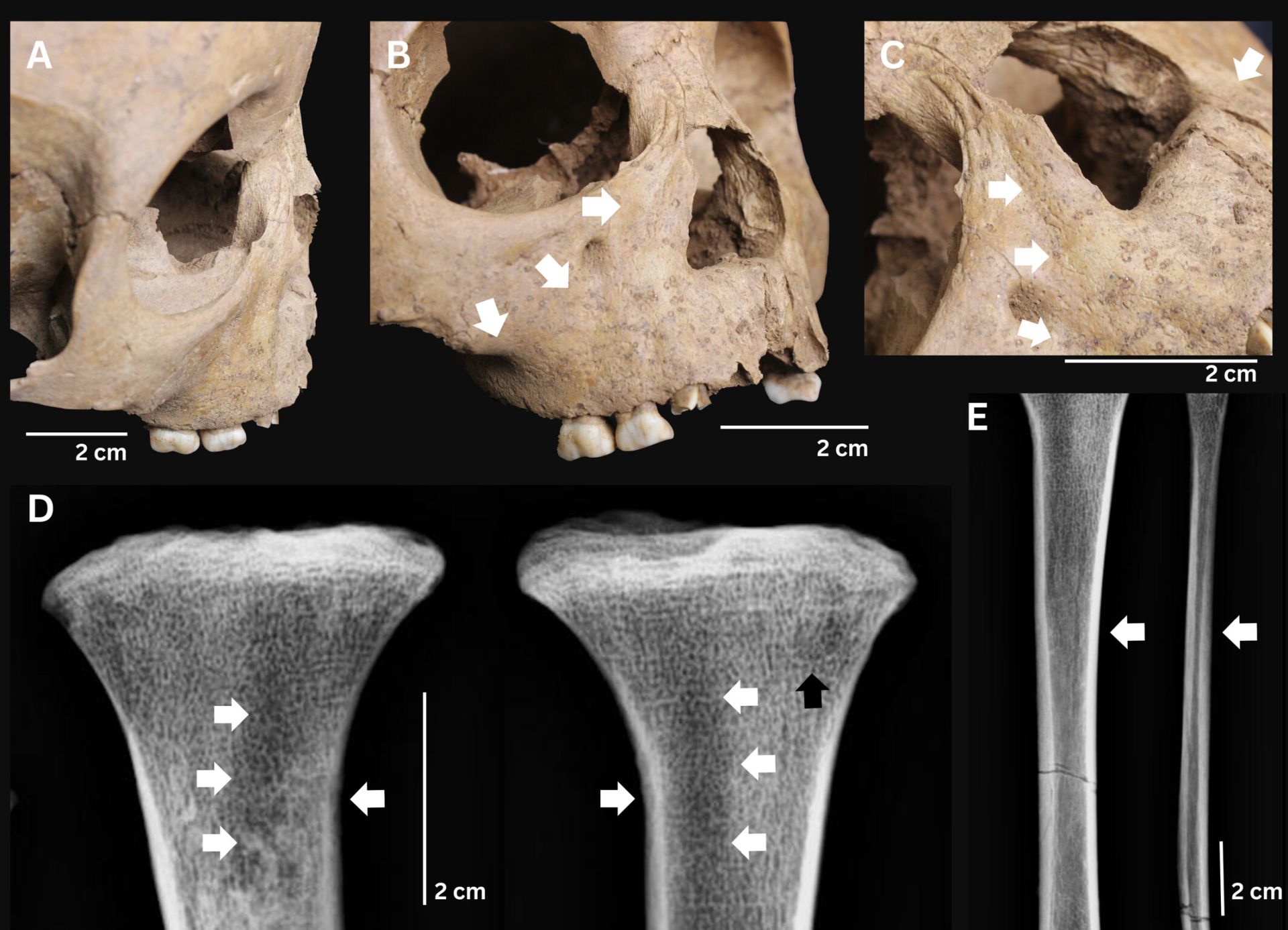 Arheologii din Vietnam au făcut o descoperire care ar putea schimba fundamental modul în care oamenii de știință înțeleg originea sifilisului, o boală cu implicații majore în istoria medicinei