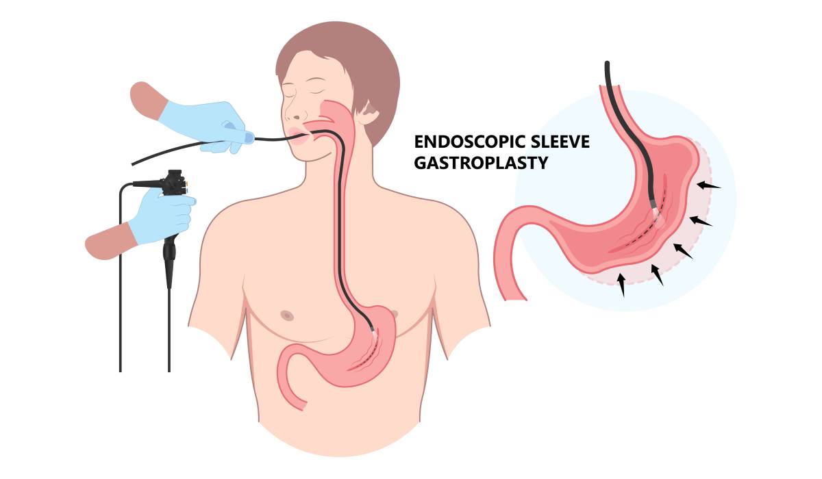EGAL cu slăbirea: Alternativa endoscopică, fără bisturiu, salvează vieți