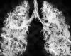 Vaporatul, un nou inamic: Cancer pulmonar și oral, riscuri majore!