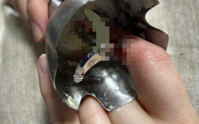 Două femei din Iași, la spital după accidente casnice grave