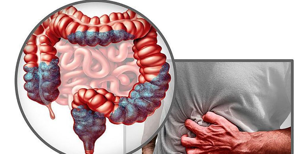 Aproape jumătate dintre adulți nu sunt conștienți de legătura dintre consumul anumitor alimente și riscul crescut de cancer colorectal