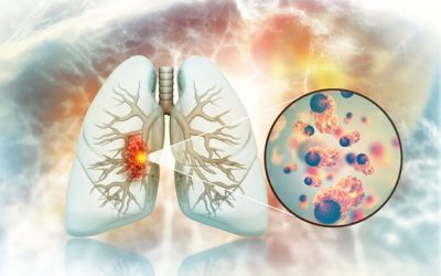 Creștere alarmantă: Cancer pulmonar la nefumători. Doctorii, uluiți de cauze