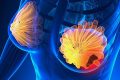 Semnale alarmante: TOP 5 simptome ale cancerului de sân. Fii atentă