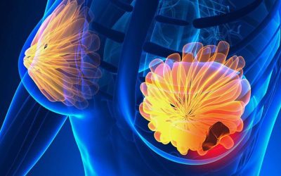 Semnale alarmante: TOP 5 simptome ale cancerului de sân. Fii atentă