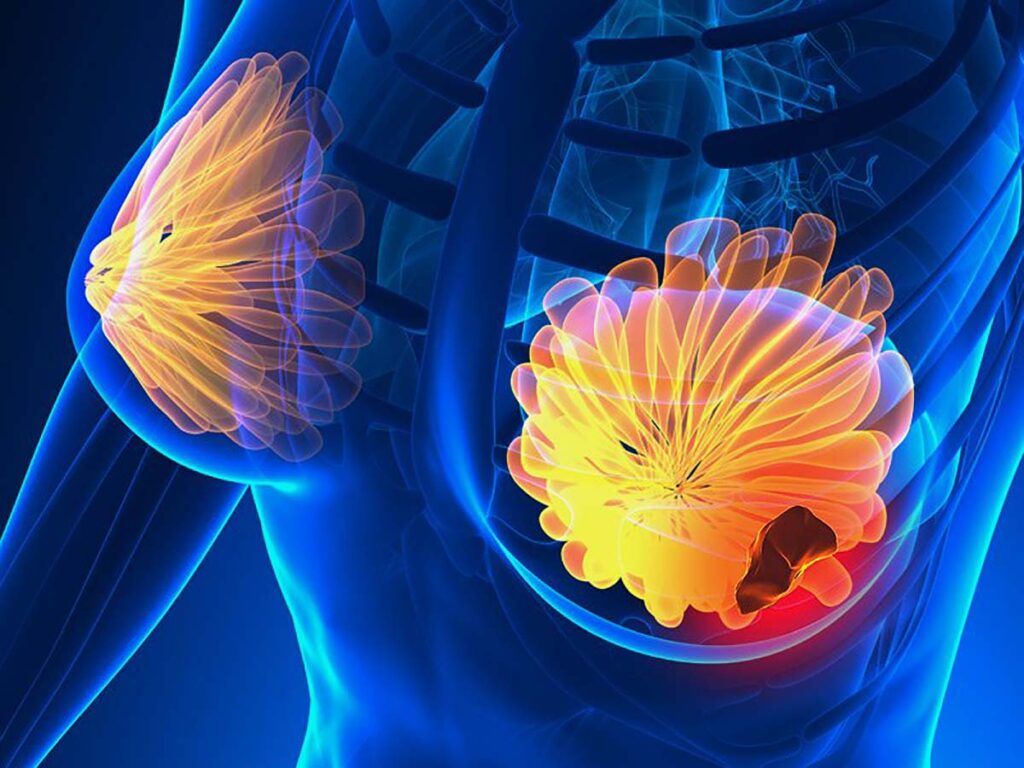 Semnale alarmante: TOP 5 simptome ale cancerului de sân. Fii atentă