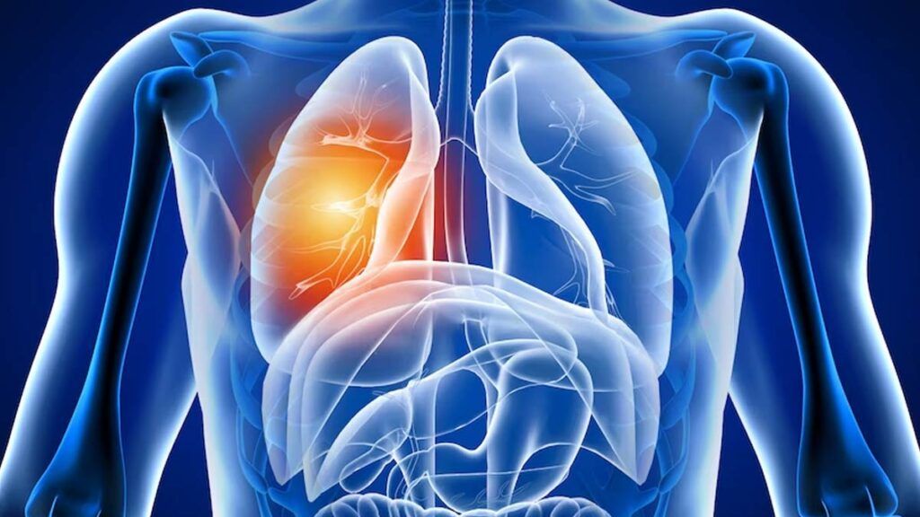 Răni nevăzute: Ce se întâmplă în plămâni după COVID-19 în România