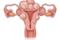 Uterul, inamicul ascuns: Fibromul poate bloca sarcina fără să știi