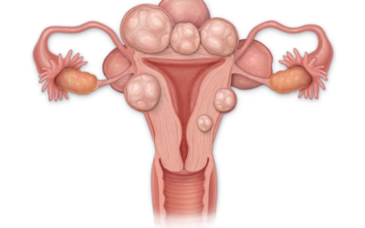 Uterul, inamicul ascuns: Fibromul poate bloca sarcina fără să știi