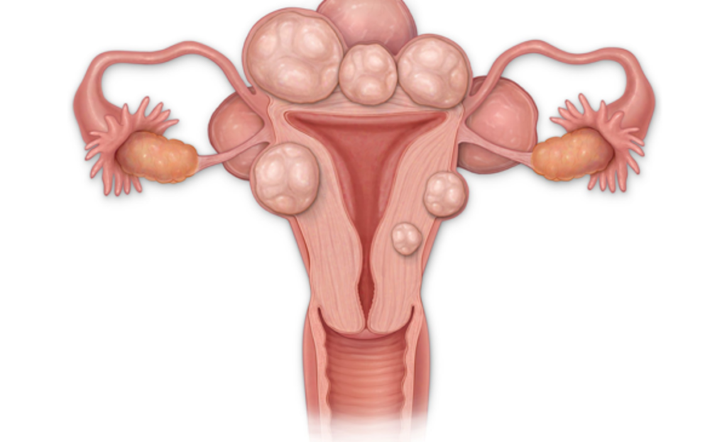 Uterul, inamicul ascuns: Fibromul poate bloca sarcina fără să știi