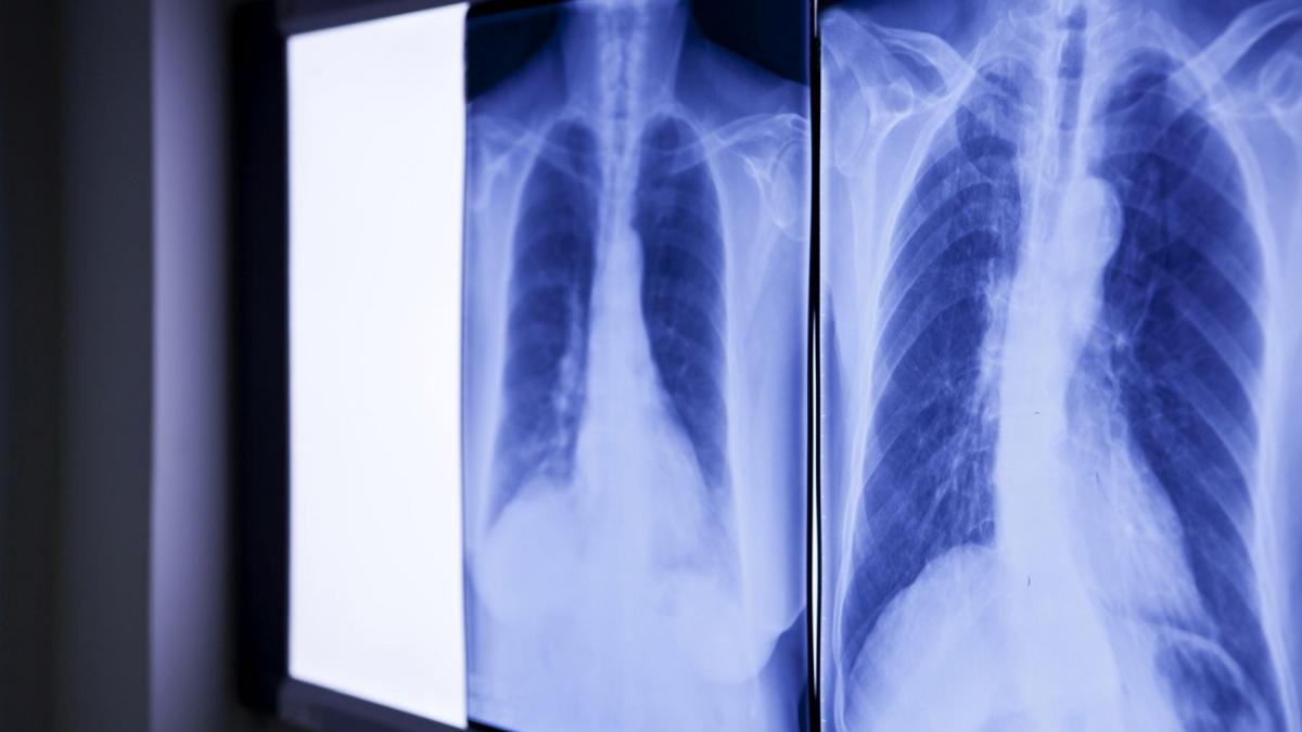 Medici, șocați: Ce au găsit în abdomenul unui bărbat, ”uitat” de 20 de ani