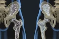 Un tratament revoluționar promite oase puternice, chiar și în osteoporoză