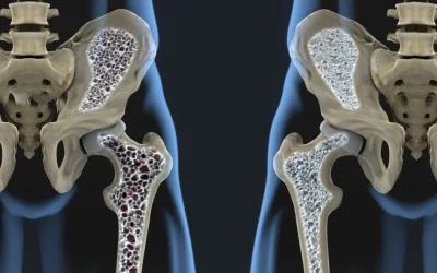 Un tratament revoluționar promite oase puternice, chiar și în osteoporoză