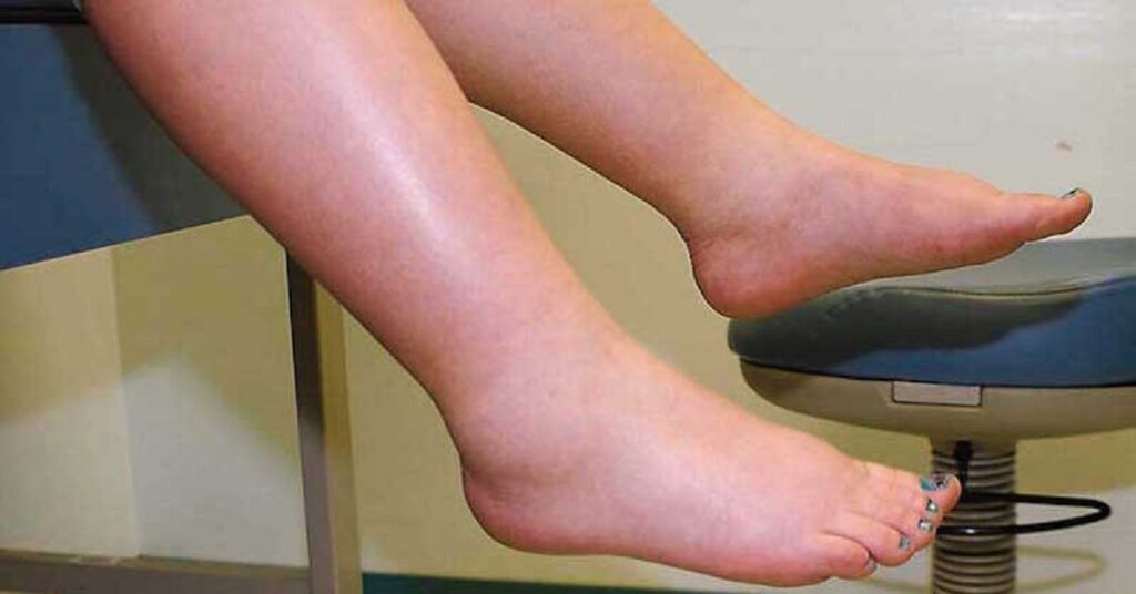 Leguma minune: Spune ADIO picioarelor umflate și circulației proaste!