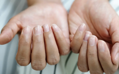 Unghiile Terry: Semnalul ascuns al bolilor grave. Ce indică, de fapt?