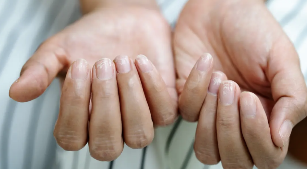 Unghiile Terry: Semnalul ascuns al bolilor grave. Ce indică, de fapt?