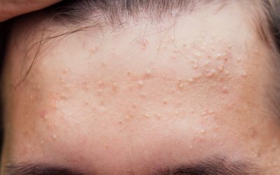 Acid salicilic: Protocolul anti-acnee în 3 pași simpli