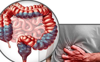 Băuturile care dublează riscul de cancer colorectal: Avertisment de la un medic