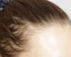 Injecții de slăbit și alopecia: Ce ascund medicii?