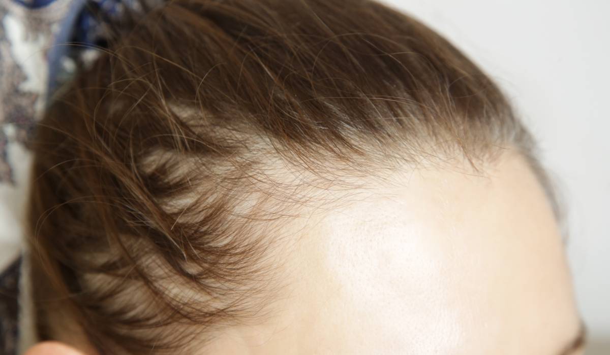 Injecții de slăbit și alopecia: Ce ascund medicii?