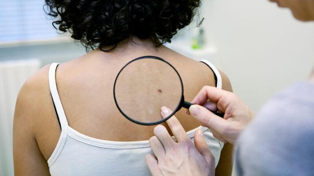 Semne de cancer piele ignorate: Nu doar alunițele ascund boala