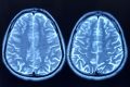 Depresia, o lovitură grea pentru neuronii noi ai creierului