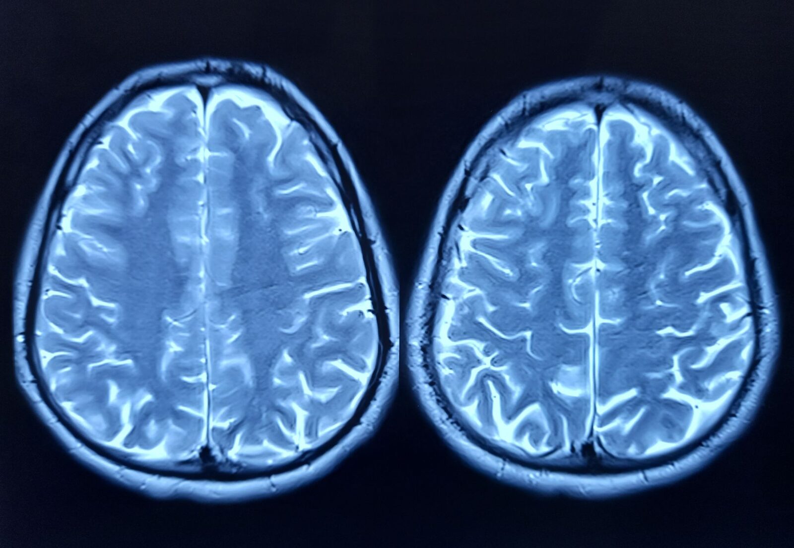 Depresia, o lovitură grea pentru neuronii noi ai creierului