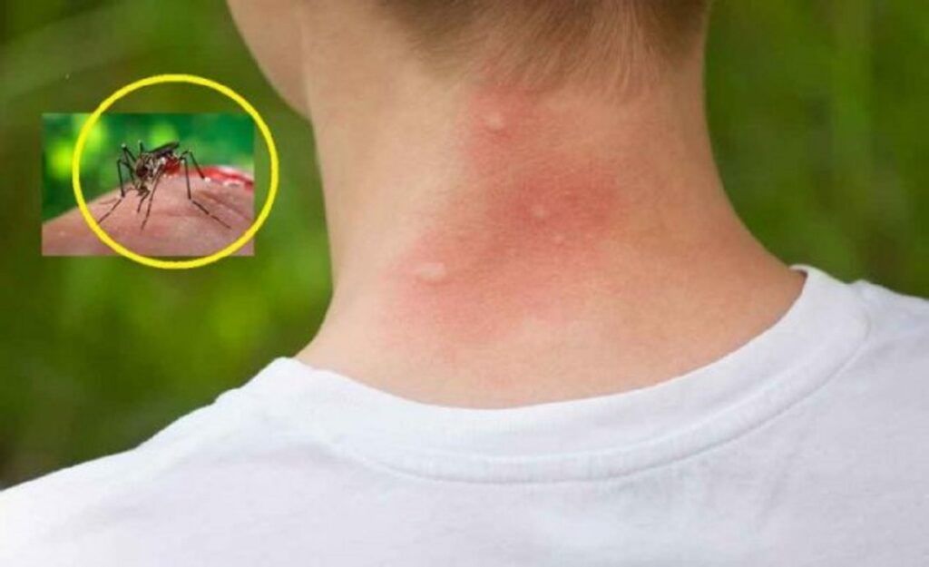 Țânțarii te aleg pe tine? Trei bacterii atacă secretul lor