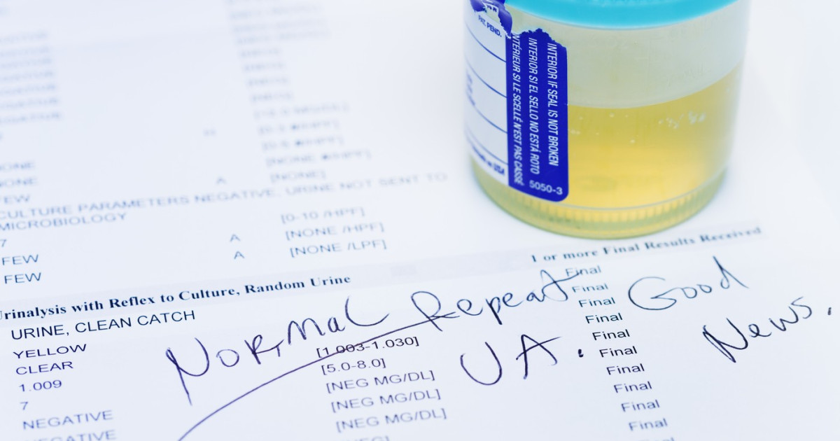Test de urină, 9 din 10 cancere de vezică depistate